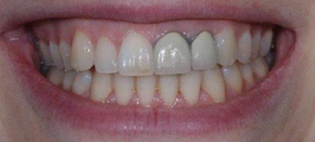 Răng toàn sứ Cercon khi sử dụng không làm đen viền nướu