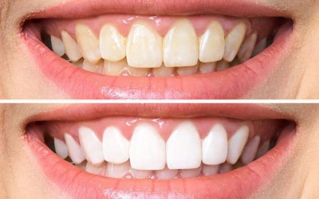 Công nghệ Bleach Bright tẩy trắng răng phù hợp với nhiều đối tượng 