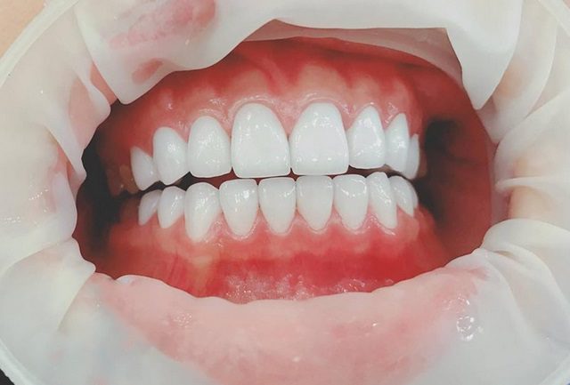 Khắc phục tốt các khuyết điểm của răng