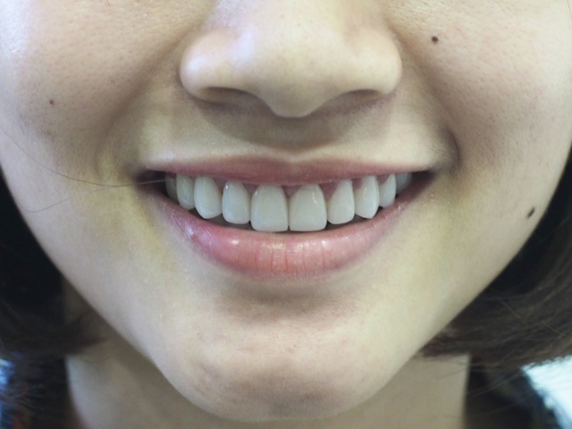 Mặt dán sứ Veneer Emax cho răng trắng đẹp