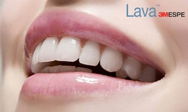 Răng sứ thẩm mỹ cao cấp Lava Plus 3M ESPE