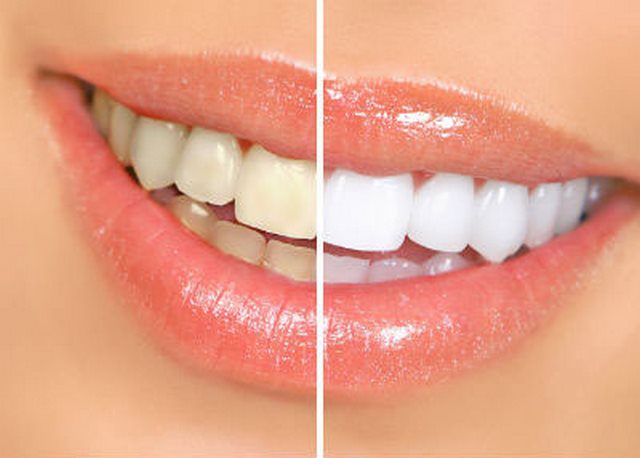 Tẩy trắng răng Bleach Bright được nhiều người ưa chuộng 